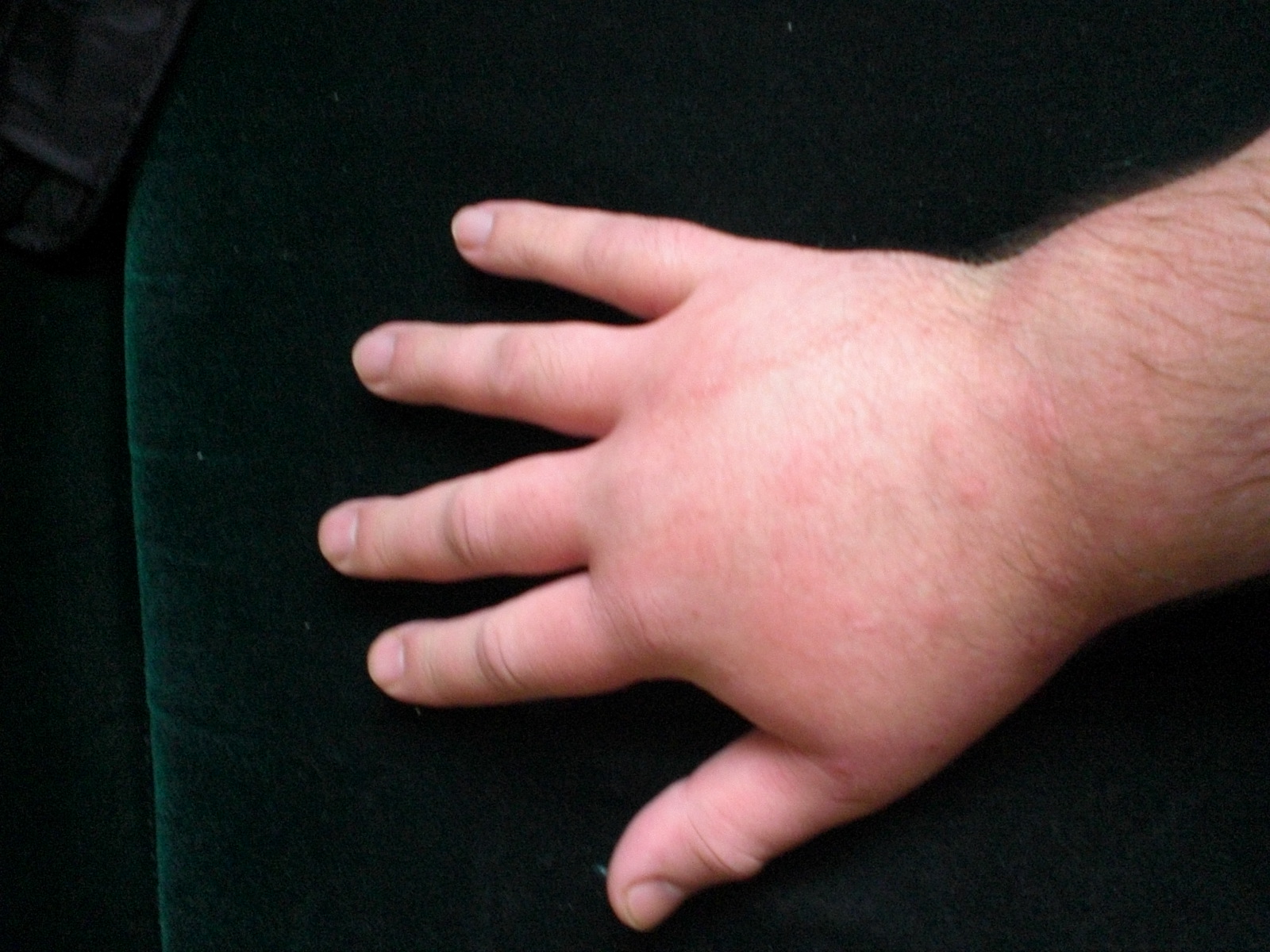 swollen itchy hands